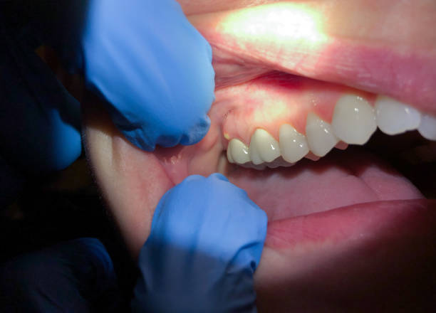 Best Knocked-Out Tooth Emergency  in Brownfield, TX